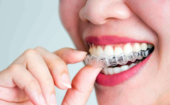 Invisalign Behandlung